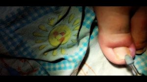 Вросший ноготь 2 часть. Ставим пластину в домашних условиях.