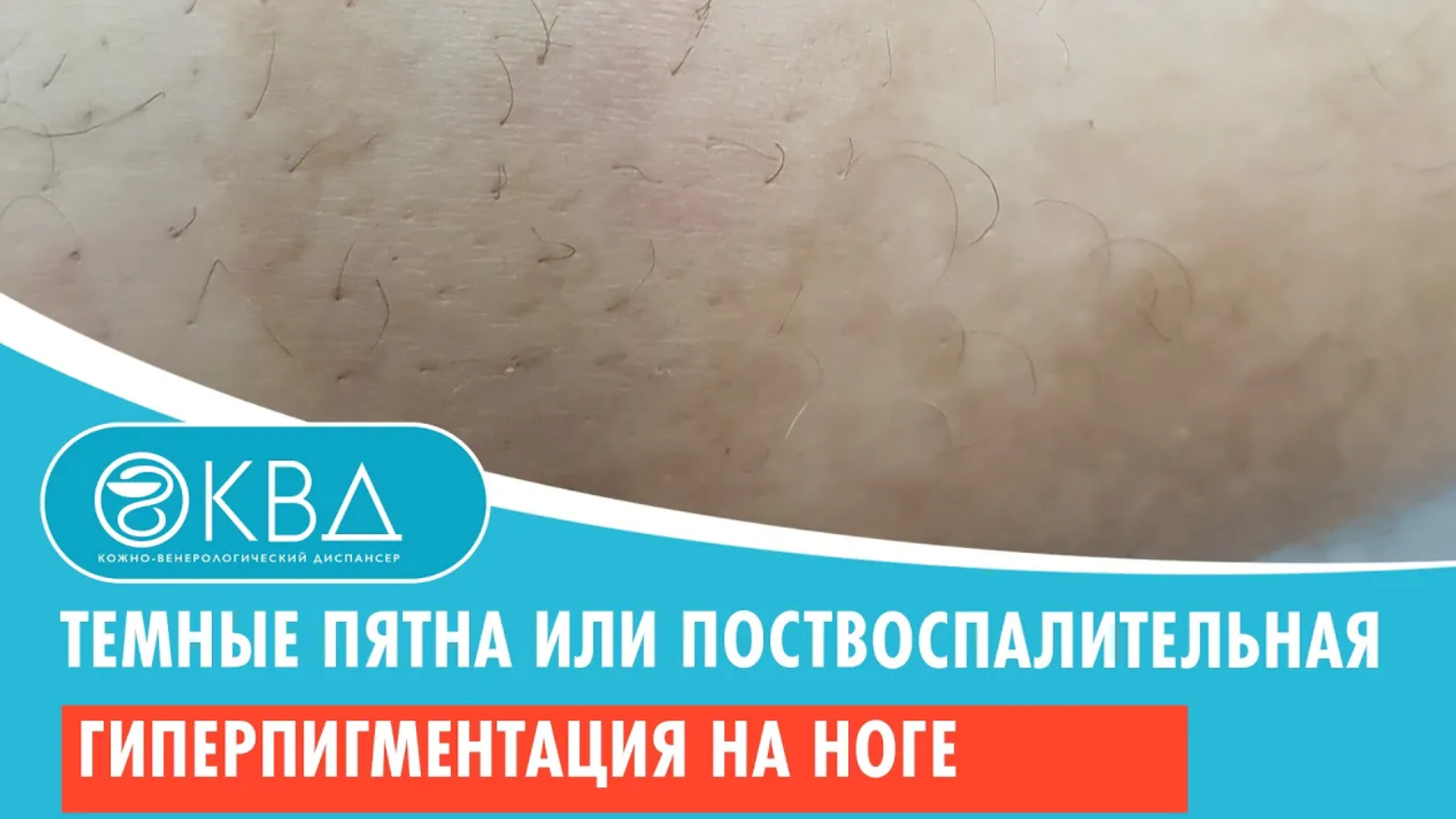 ? Темные пятна или поствоспалительная гиперпигментация на ноге.  Клинический случай №906