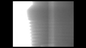Микроподвижность в системе абатмент-имплантат. Причины и последствия