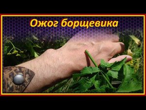 Ожог желтого борщевика / воздействие сока борщевика на кожу