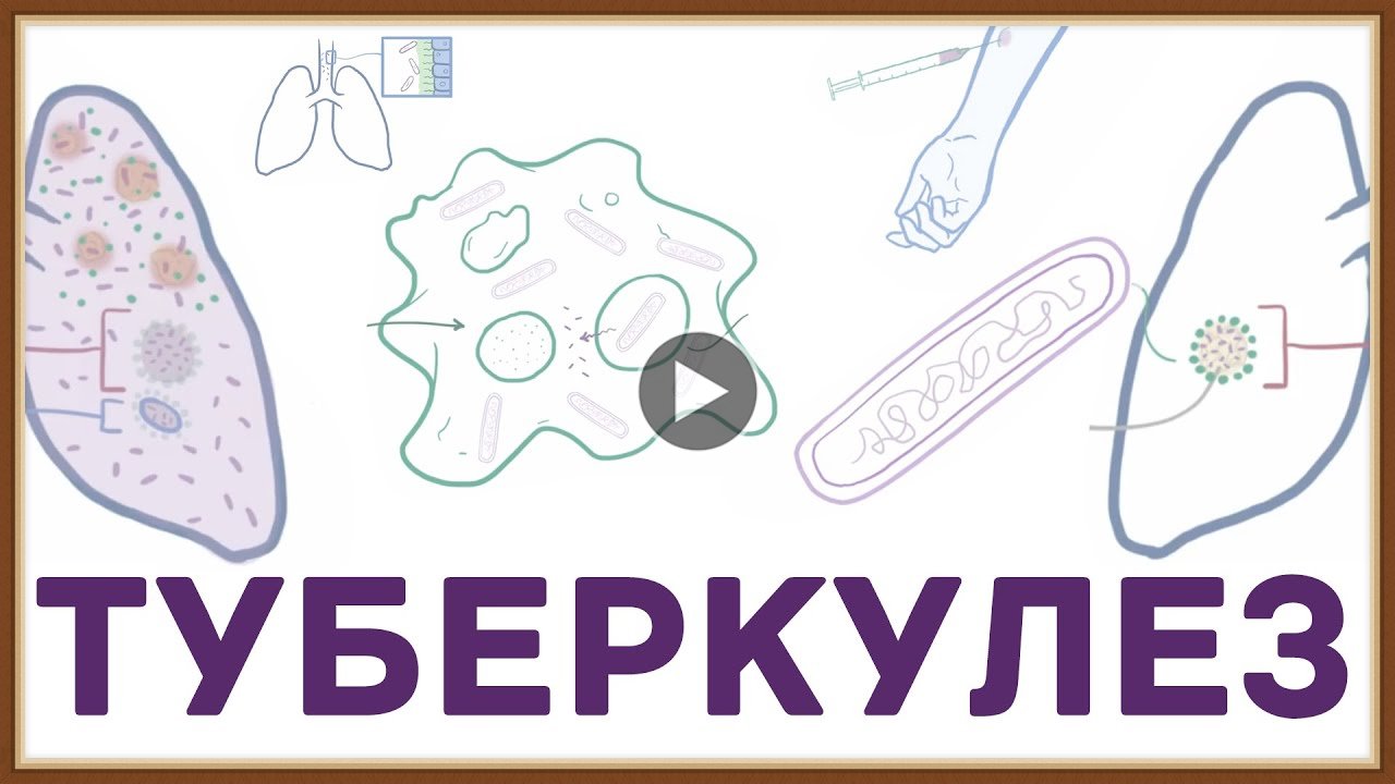 ТУБЕРКУЛЕЗ - ЧТО НАДО ЗНАТЬ