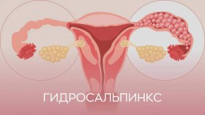 🕵️♀️ Гидросальпинкс: как связан с бесплодием?