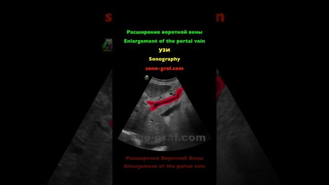 УЗИ - Расширение воротной вены