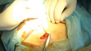 Fibroma Removal/ Удаление фибромы