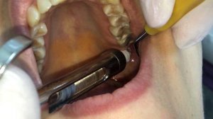 lower jaw block Gow-Gates (анестезия по Гоу-Гейтсу)