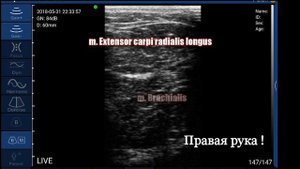 Портативный УЗИ датчик UProbe. Проводниковая анестезия верхней конечности. ч 5