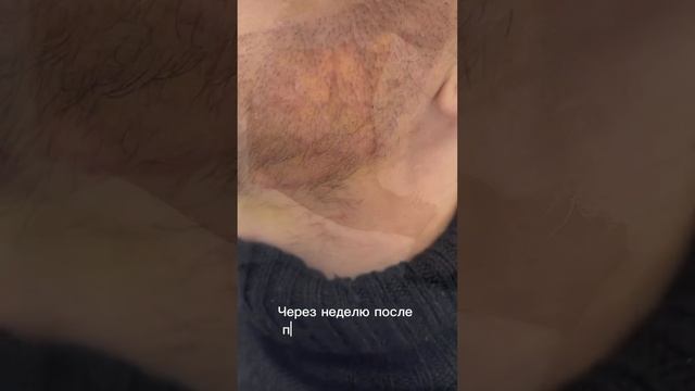 Пересадка бороды имплантером ? #shorts #пересадкабороды #пересадкаволос ##трансплантацияволос