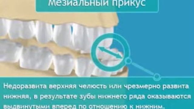Неправильный прикус разновидности и причины возкикновения смотреть онлайн