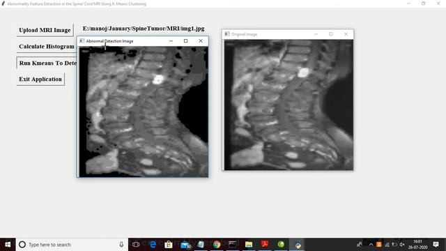 Abnormality Feature Extraction in the Spinal Cord MRI Using K-Means Clustering смотреть онлайн