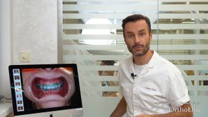 Самые популярные цвета резинок для брекетов. Как смотрятся на зубах