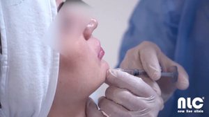 DR. ВАЛЕРИЙ ПОТИЙ - КОНТУРНАЯ ПЛАСТИКА ГУБ ФИЛЕРОМ STYLAGE M LIDOCAINE