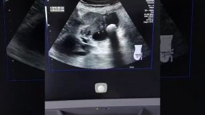 Рак желчного пузыря.