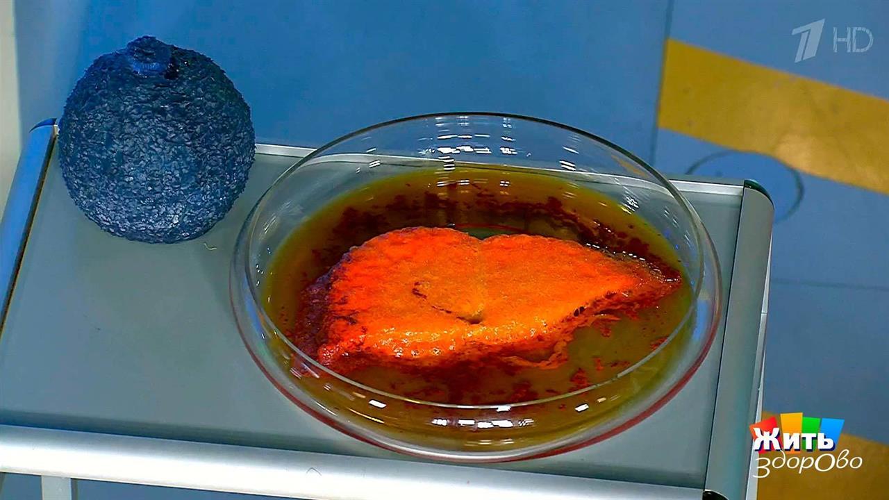 Микробы-диверсанты. Гепатит С. Жить здорово! Фрагмент выпуска от 06.07.2017