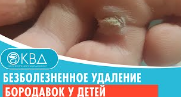 ✔ Безболезненное удаление бородавок у детей. Клинический случай №707