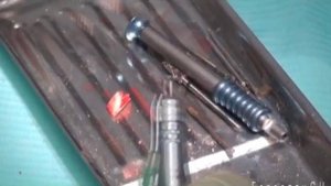 Наращивание костной ткани для имплантации  в области 12 зуба