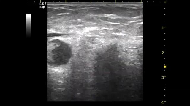 Болезнь Кошачьих Царапин смотреть онлайн