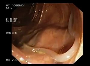 Паразиты в кишечнике: глисты,солитеры,аскариды,острицы,гельминты,черви (симптомы,признаки,лечение)