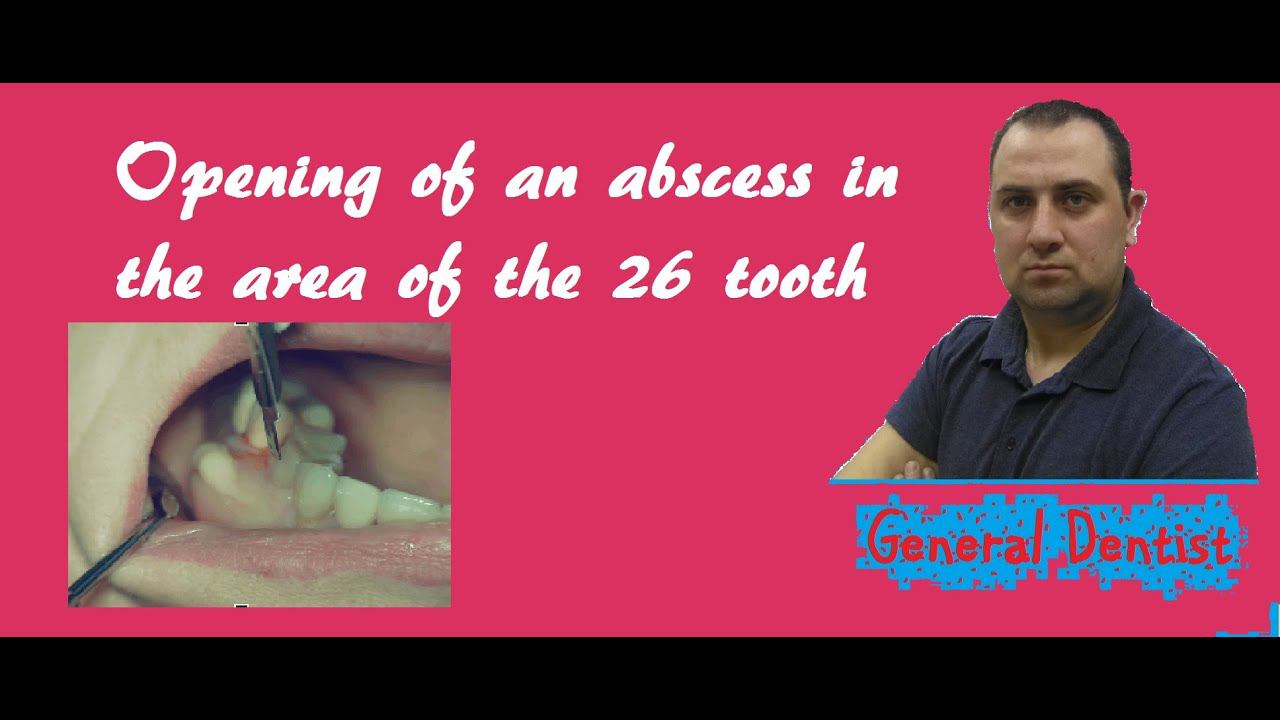 Opening of an abscess in the area of the 26th tooth.