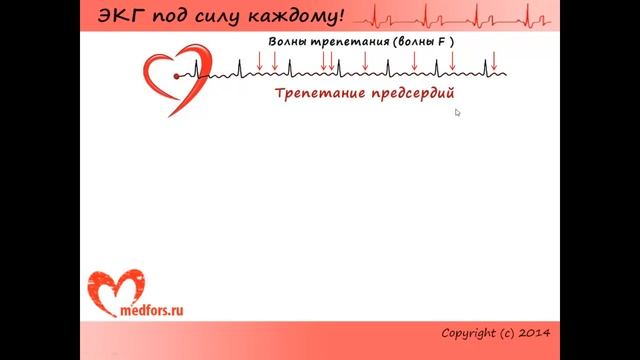 Нарушения ритма сердца - несинусовые тахикардии, трепетания и фибрилляции смотреть онлайн