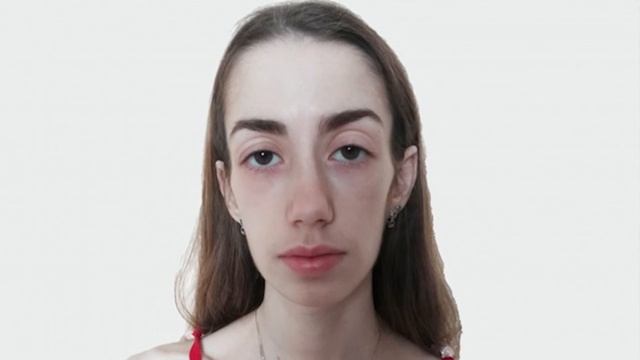 Милонов и анорексия