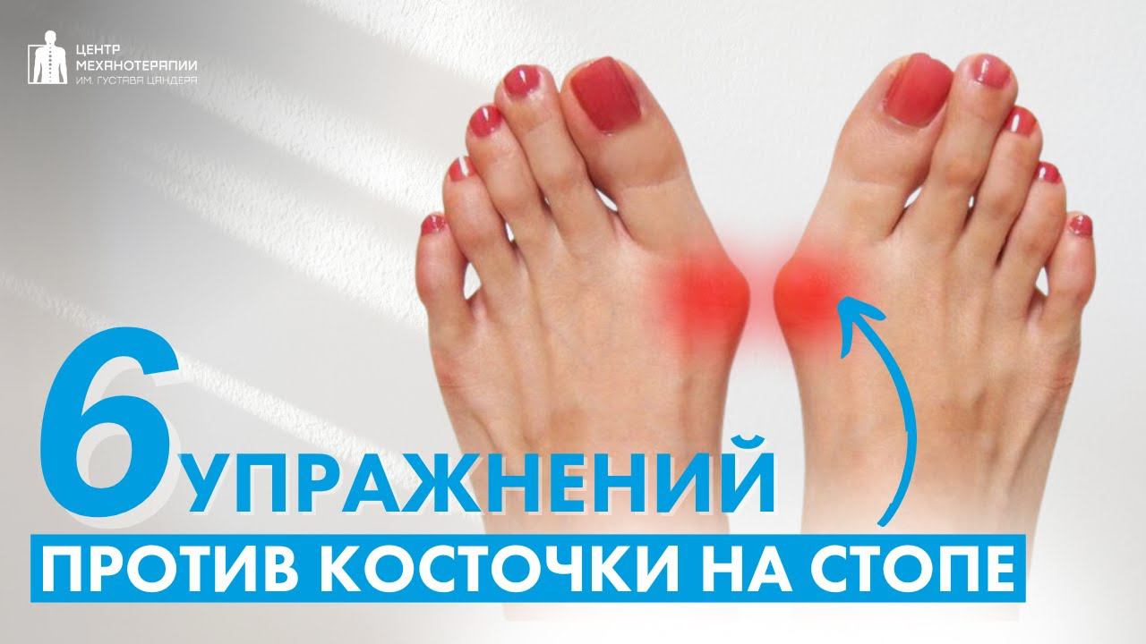 Как убрать косточку на стопе? Делайте эти упражнения смотреть онлайн