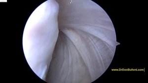 R Shoulder Rotator Cuff Repair and Biceps Tenodesis  2018 02 01 AT