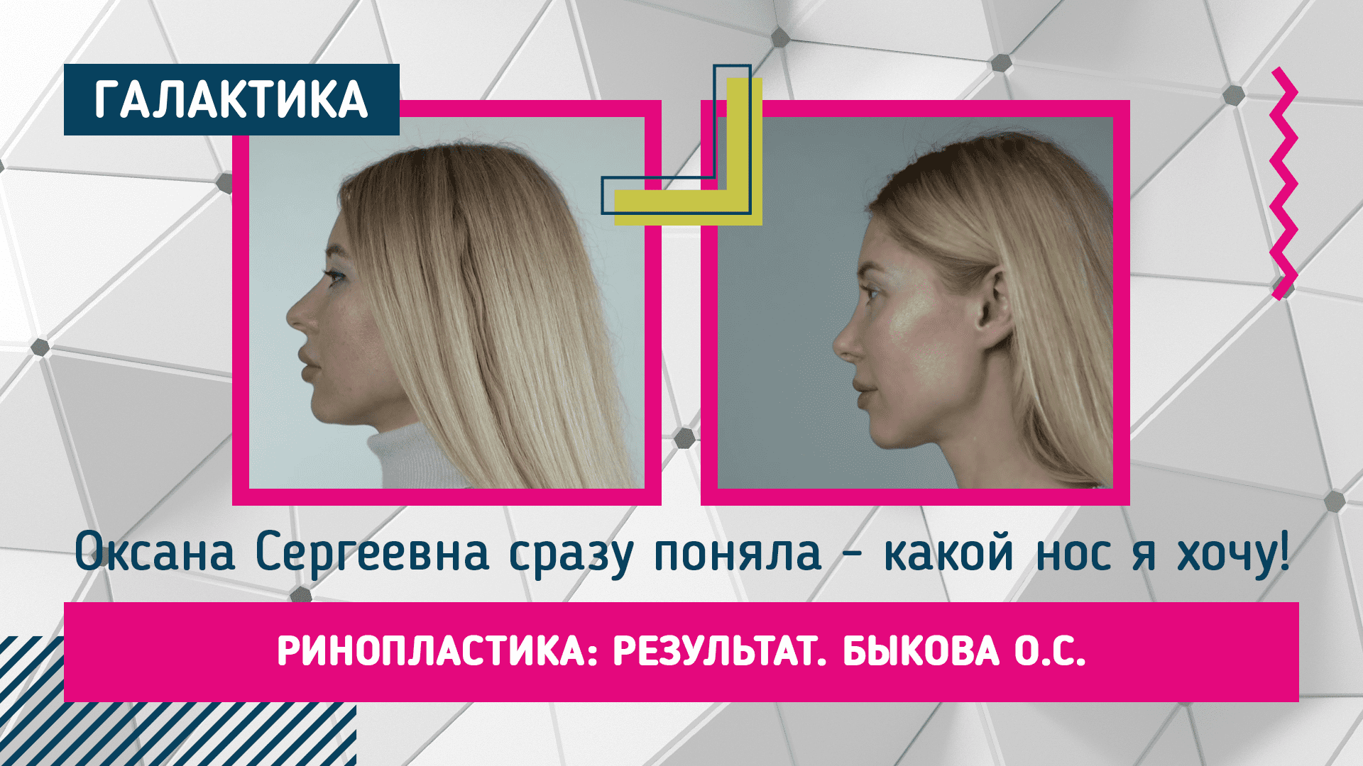 Ринопластика: результат | Быкова Оксана Сергеевна