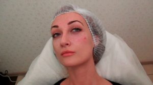 коррекция скул филлером на основе гиалуроновой кислоты