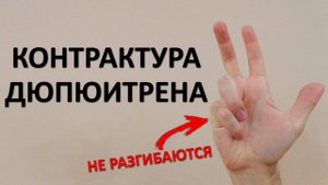 Контрактура Дюпюитрена. В чём причина? Как лечить дома? Нужна ли операция?