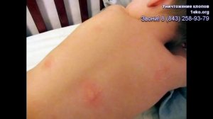 Подборка фото укусов клопов на теле человека