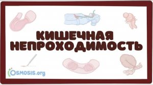 Острая кишечная непроходимость (хирургия лекция) Osmosis