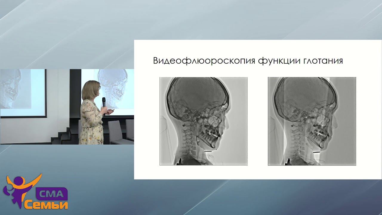 Нарушения функции глотания. От альтернативных способов кормления к естественным