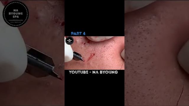 Blackheads Removal#21 смотреть онлайн