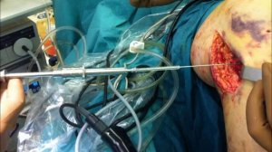 Остеосинтез большеберцовой кости