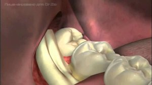 Удаление зуба мудрости