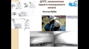 Доброкачественное пароксизмальное позиционное головокружение (ДППГ): диагностика и лечение