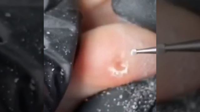 Фрезы для стержневой мозоли и не только смотреть онлайн