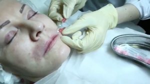 Коррекция кисетных морщин с помощью нитевого лифтинга.