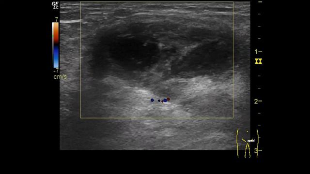 Грыжа 7 смотреть онлайн