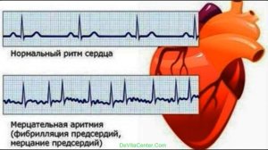 МЕРЦАТЕЛЬНАЯ АРИТМИЯ