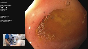 05Live Иванова ЕВ Экспертная Колоноскопия при язвенном колите