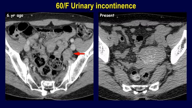 Solid ovarian tumors 1/2 - Brenner tumor смотреть онлайн
