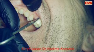 Состояние после имплантации 25. Снятие швов