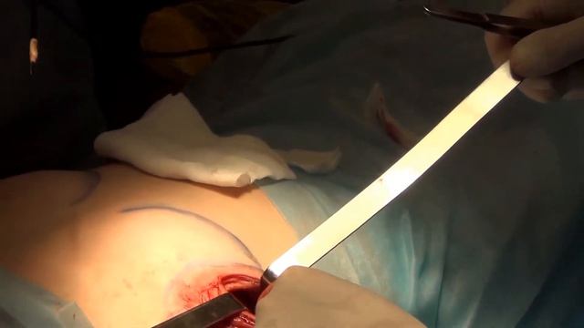 Маммопластика: коррекция формы соска в ОН КЛИНИК смотреть онлайн