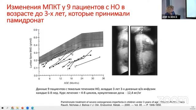 Несовершенный остеогенез. Современный взгляд на диагностику и лечение