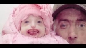 Мать упала при виде её! КАК сейчас выглядит Дарина Шпенглер которая родилась БЕЗ губ и подбородка..