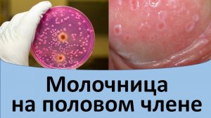 Кандидоз у мужчин