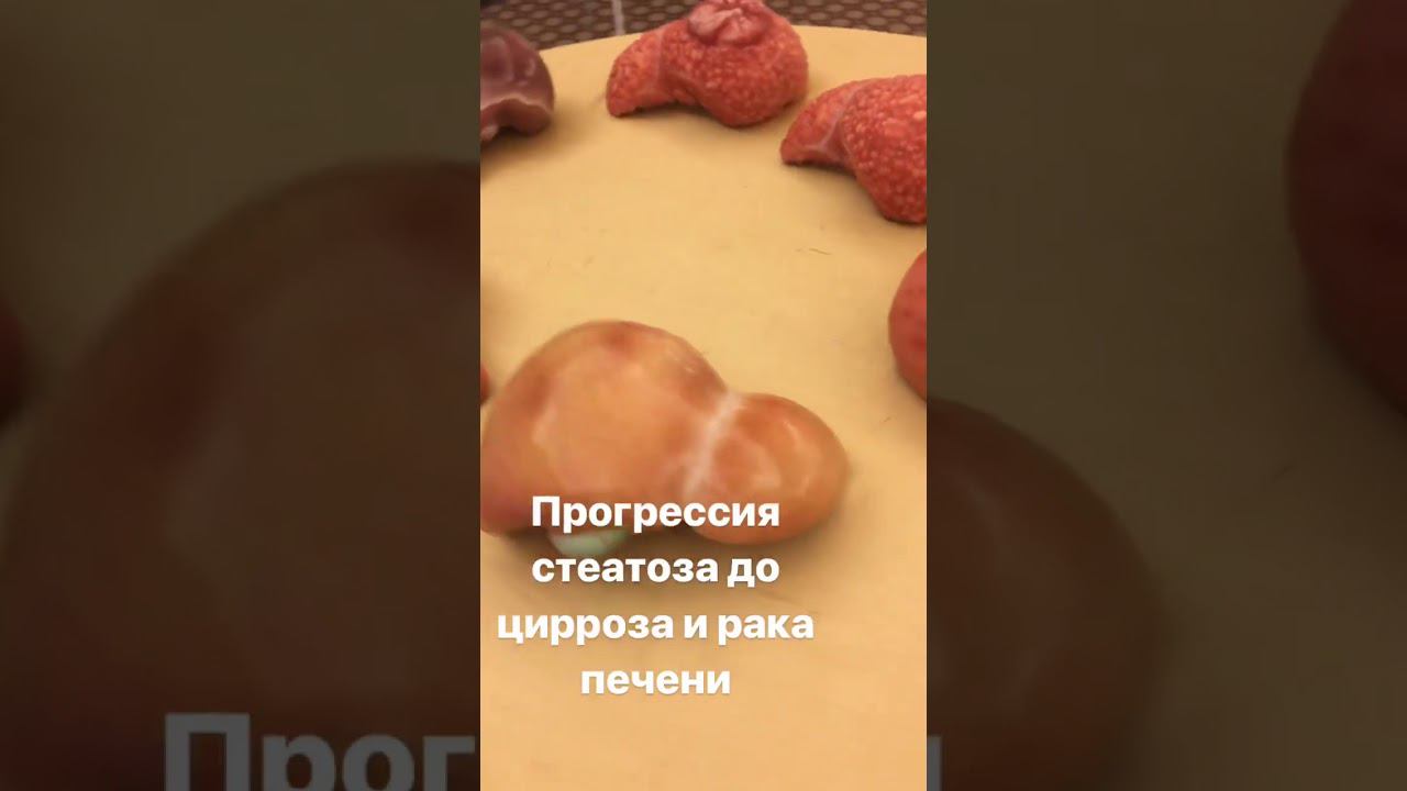 Стеатоз печени до цирроза и рака