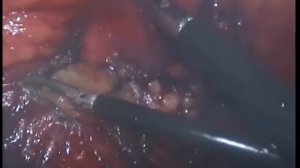 Лапароскопическое удаление почки