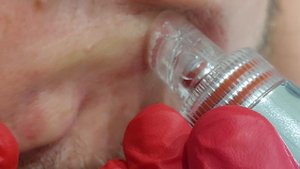 вакуумный гидропилинг